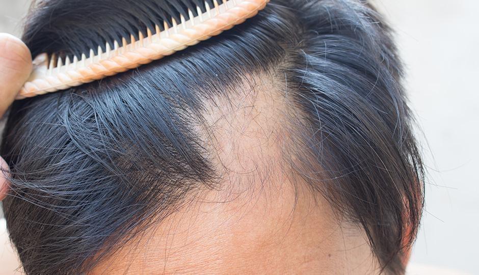 is-it-time-to-get-help-with-your-hair-loss Blog
