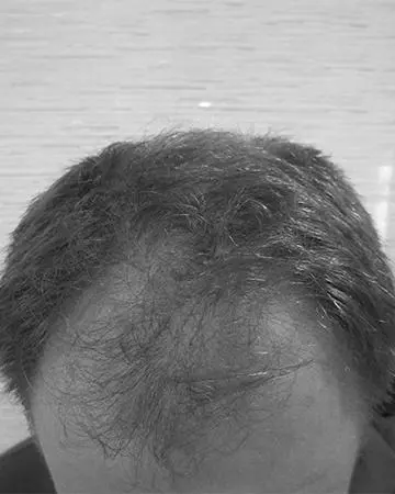   solutions before after mens gallery 18 mens hair loss solutions before and after photo 02
