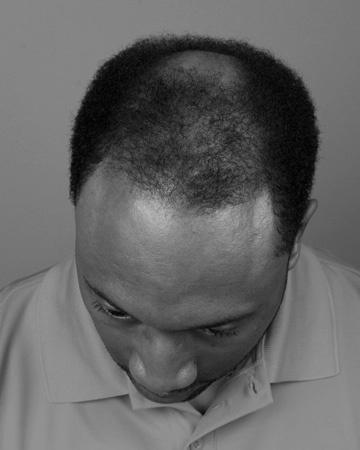   solutions before after mens gallery 30 mens hair loss solutions before and after photo 02