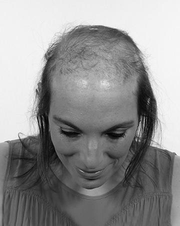   solutions before after womens gallery 15 womens hair loss solutions before and after photo 02